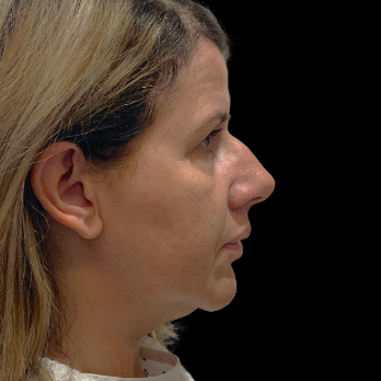 ultrasonic-rhinoplasty-before